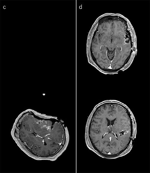 Surgical decision mri two