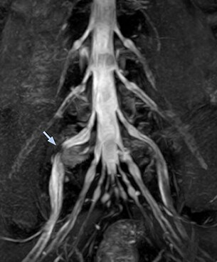 MRI of right L5 radiculopathy