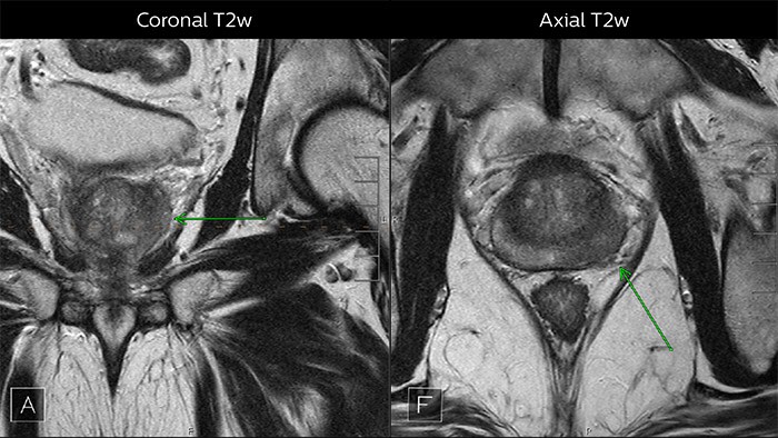 Coronal T2w vs Axial T2w