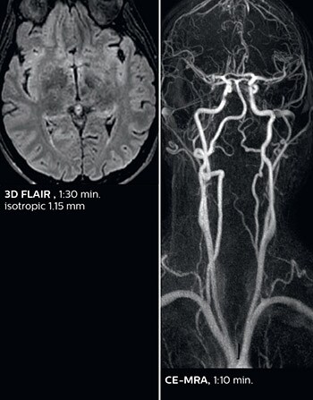 Fast acute stroke protocol B