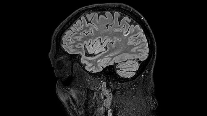 Juxtacortical MS lesion elition