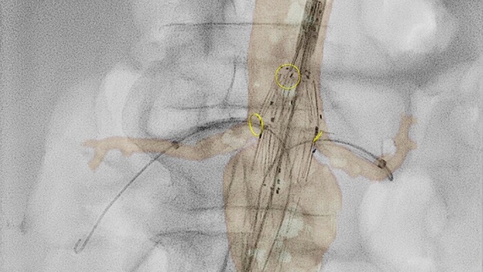 2d perfusion vascular