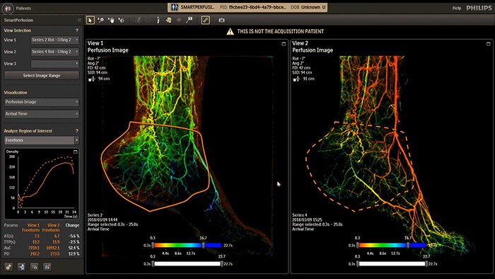SmartPerfusion digital subtraction angiography