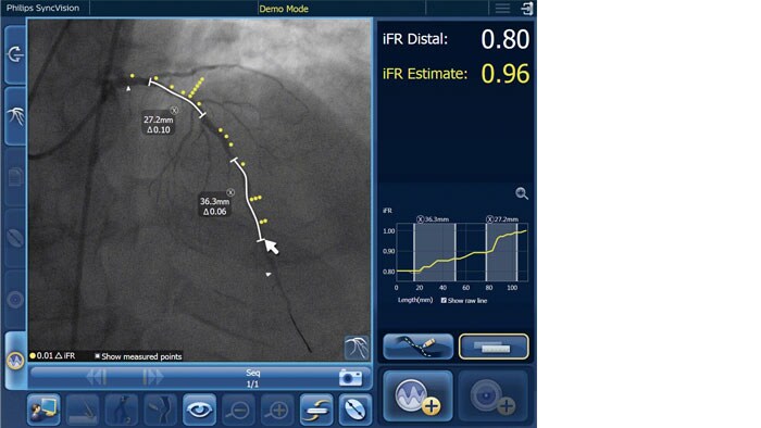 iFR co-registration still